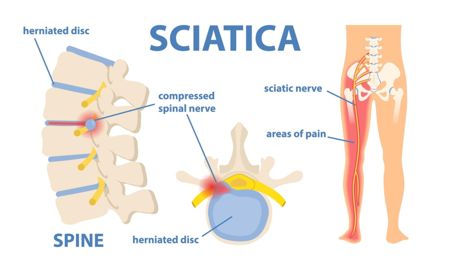 SCIATICA