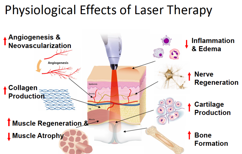 Experience Advanced Healing with Cutting-Edge Class IV Laser Therapy in St. Charles, MO