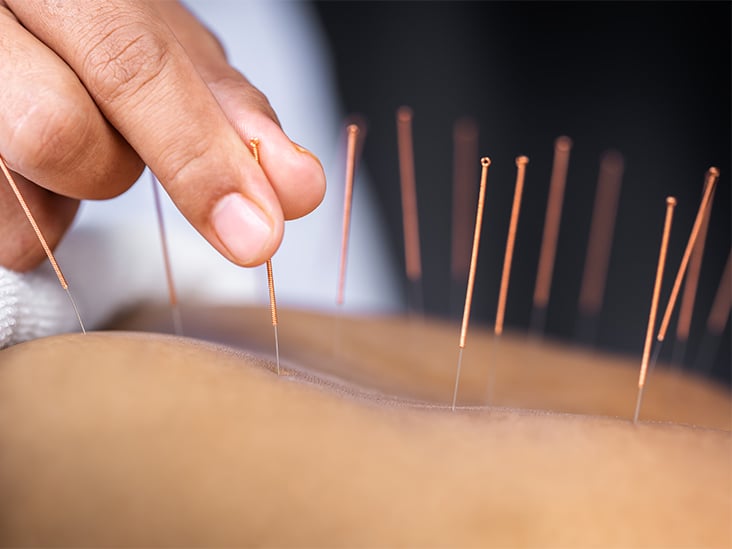 Acupuncture: Ancient Healing for Fast, Natural Pain Relief