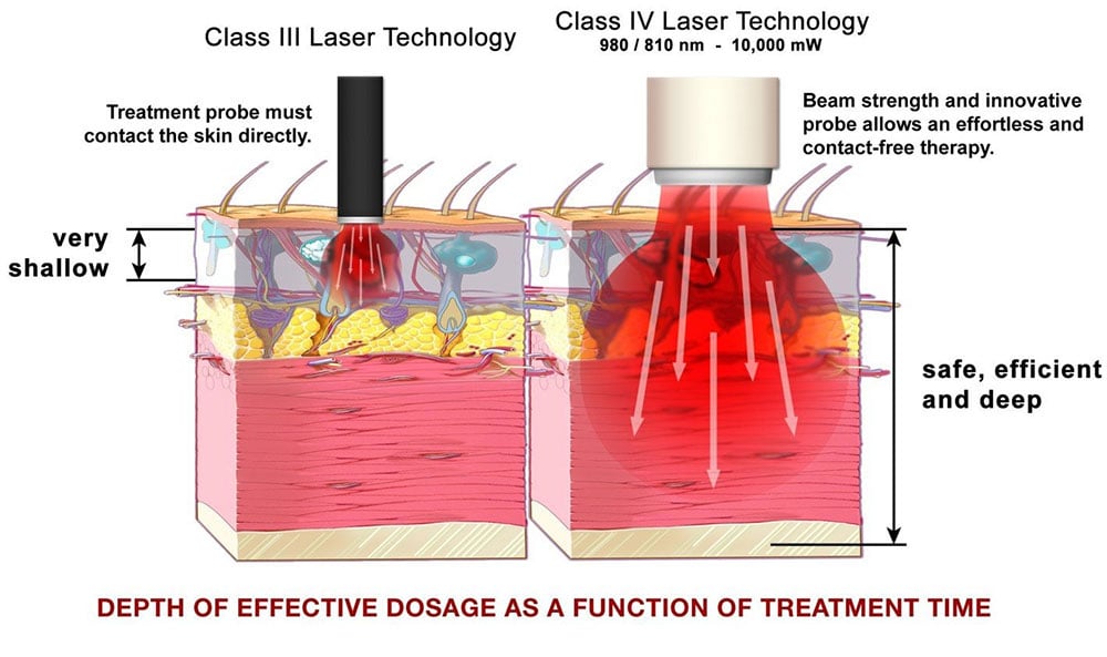 Class IV Laser Therapy vs Class 3 Laser Therapy